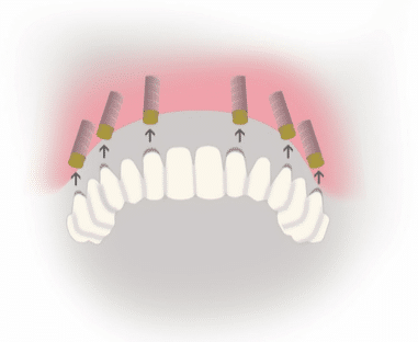 Le bridge complet sur implants