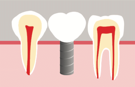 implant artificiel