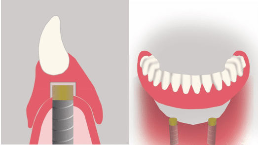 stabilisation prothese amovible