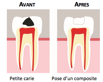 traitement petite carie