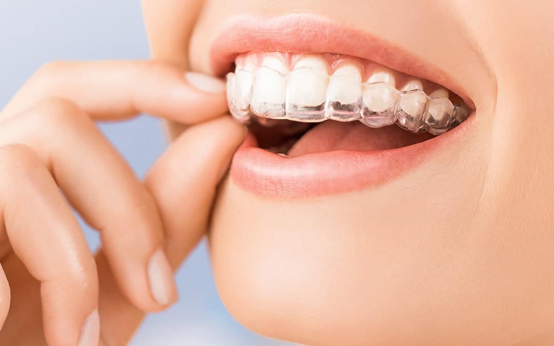 Orthodontie par aligneurs invisibles