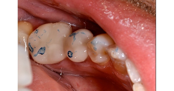 resulata usinage cerec 2011 v2